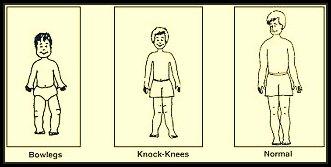 bowlegs knock-knees and normal legs 