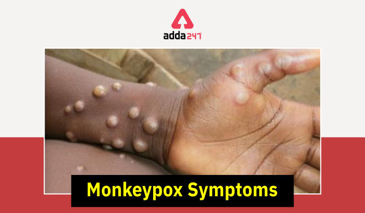 Monkeypox Virus: History, Outbreak, Symptoms Virus 2022_30.1