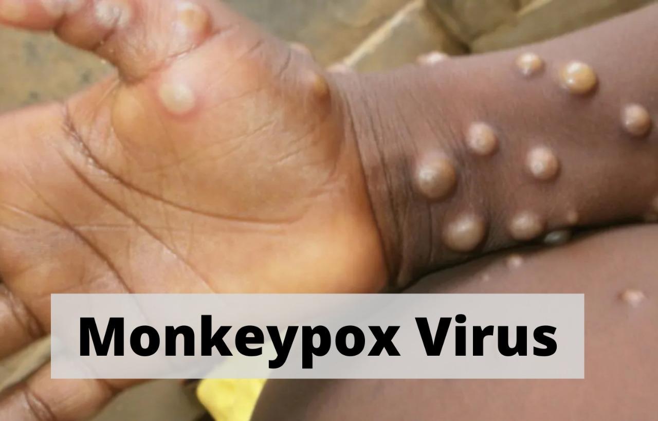 Monkeypox virus: what it is, how it spreads, what causes it | మంకీపాక్స్ వైరస్: అది ఏమిటి, అది ఎలా వ్యాపిస్తుంది, దానికి కారణం ఏమిటి?_30.1