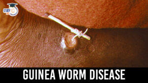 Guinea Worm Disease, Causes, Symptoms and Global Effort