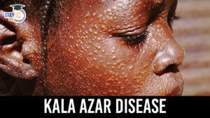 Kala Azar Disease, Less Than One Case Per 10,000 Population in India