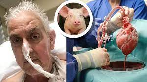 David Bennett world first human receives a Pig Heart Transplant_50.1