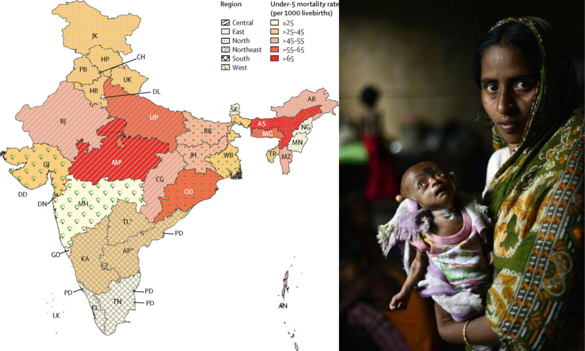 India's under-5 mortality rate declines by 3 points; largest drops in UP and Karnataka
