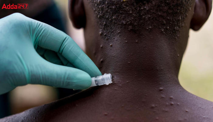 Monkeypox Disease Name Changed to Mpox by WHO_40.1
