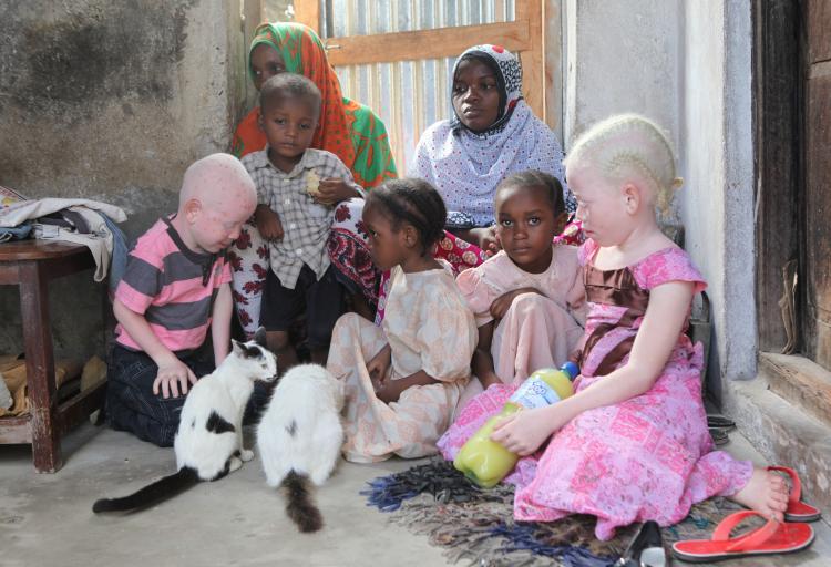 International Albinism Awareness Day 2023: Date, Theme, and History_30.1