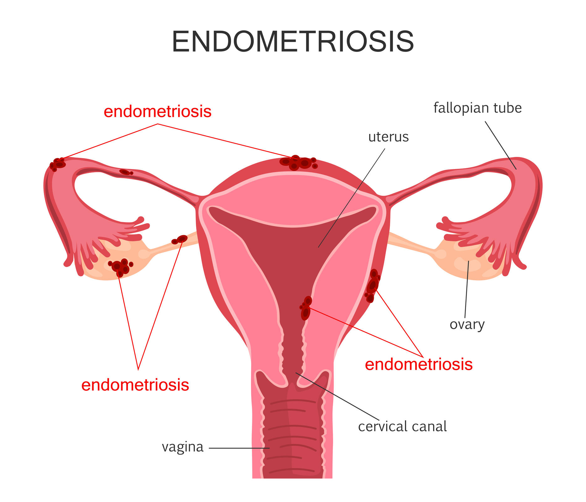 The link between endometriosis and an infectious bacterium_50.1