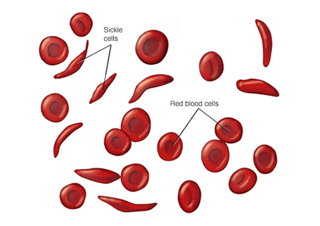 National Sickle Cell Anaemia Mission_4.1