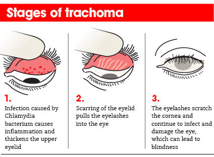 India Eliminates Trachoma Disease: WHO_4.1